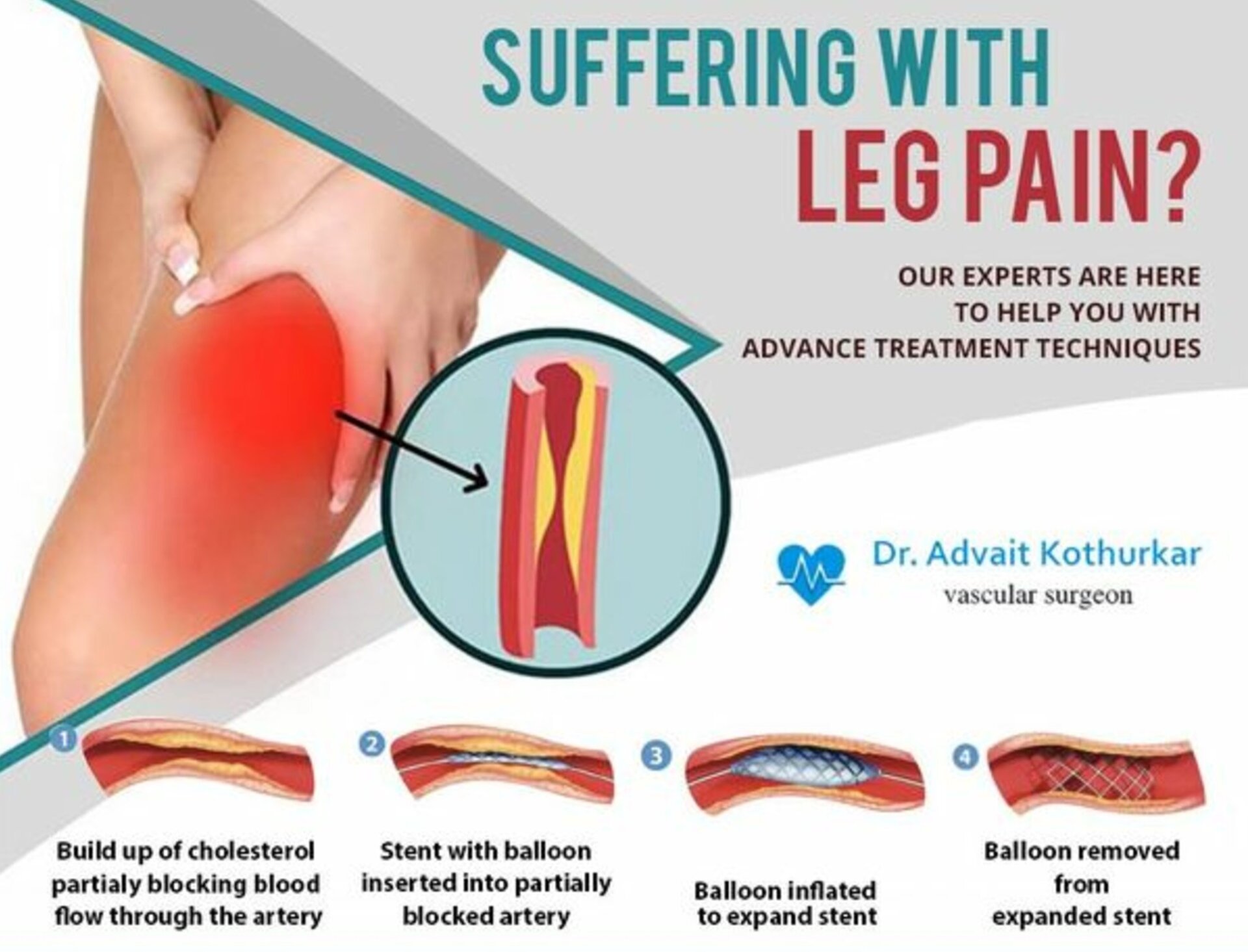 Leg Pain | Dr. Advait Kothurkar