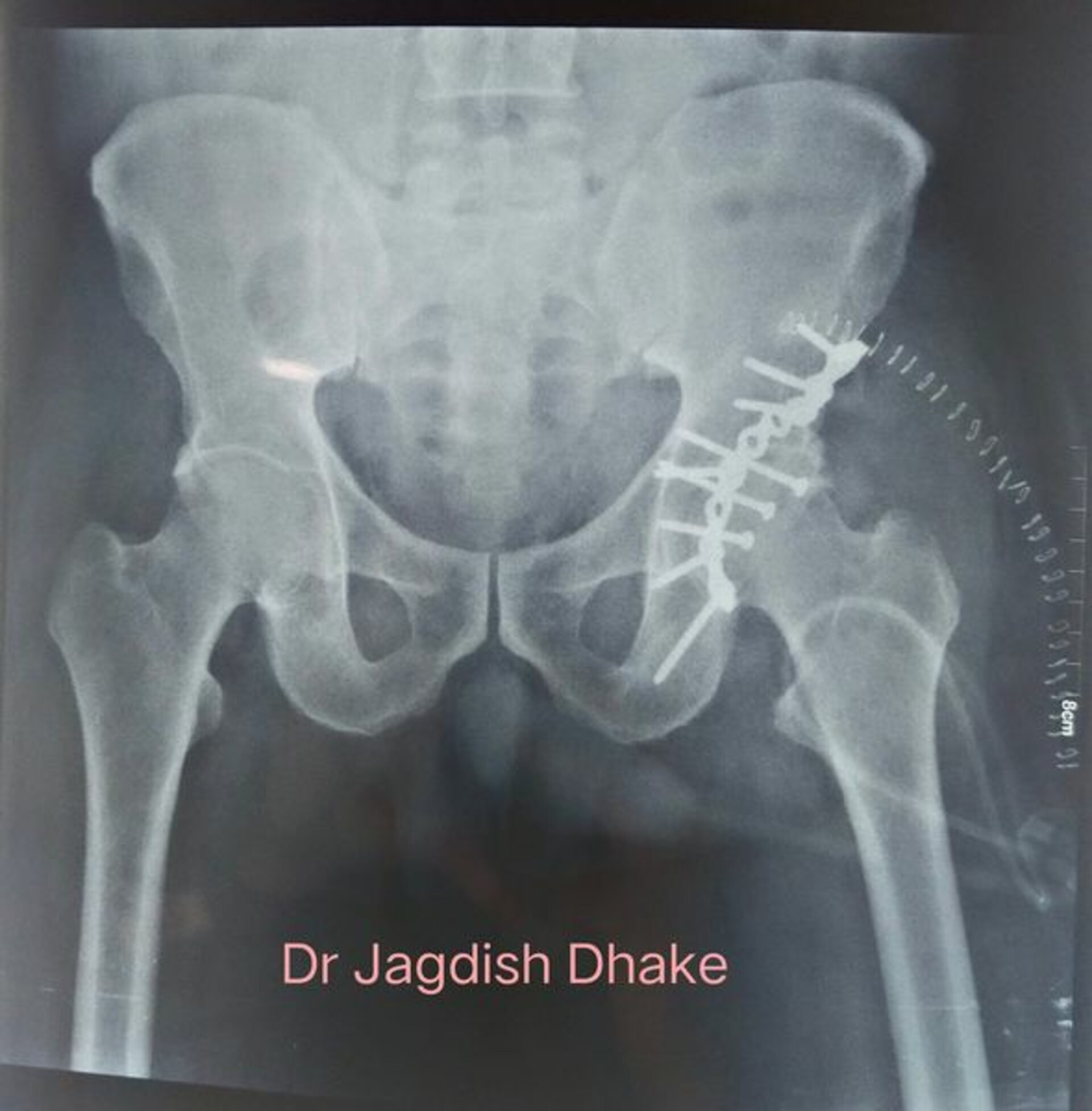 Comminuted acetabular fracture fixation | Dr. Jagdish Dhake