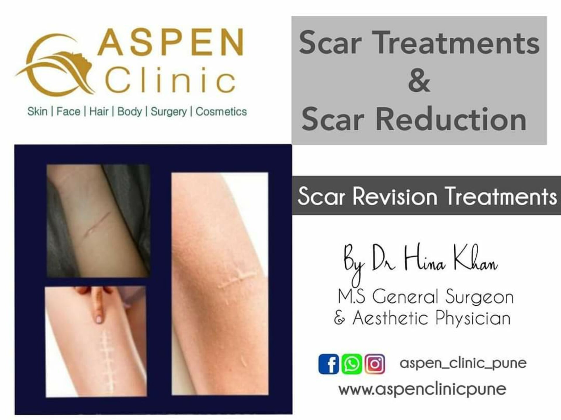 Scar Revision Treatments in Kondhwa