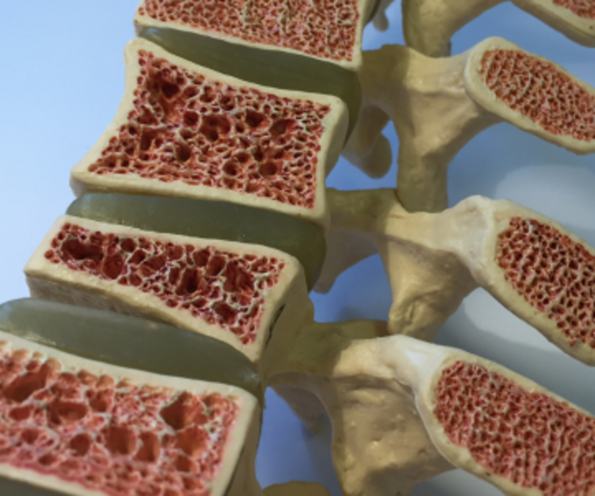 osteoporosis treatment in Noida