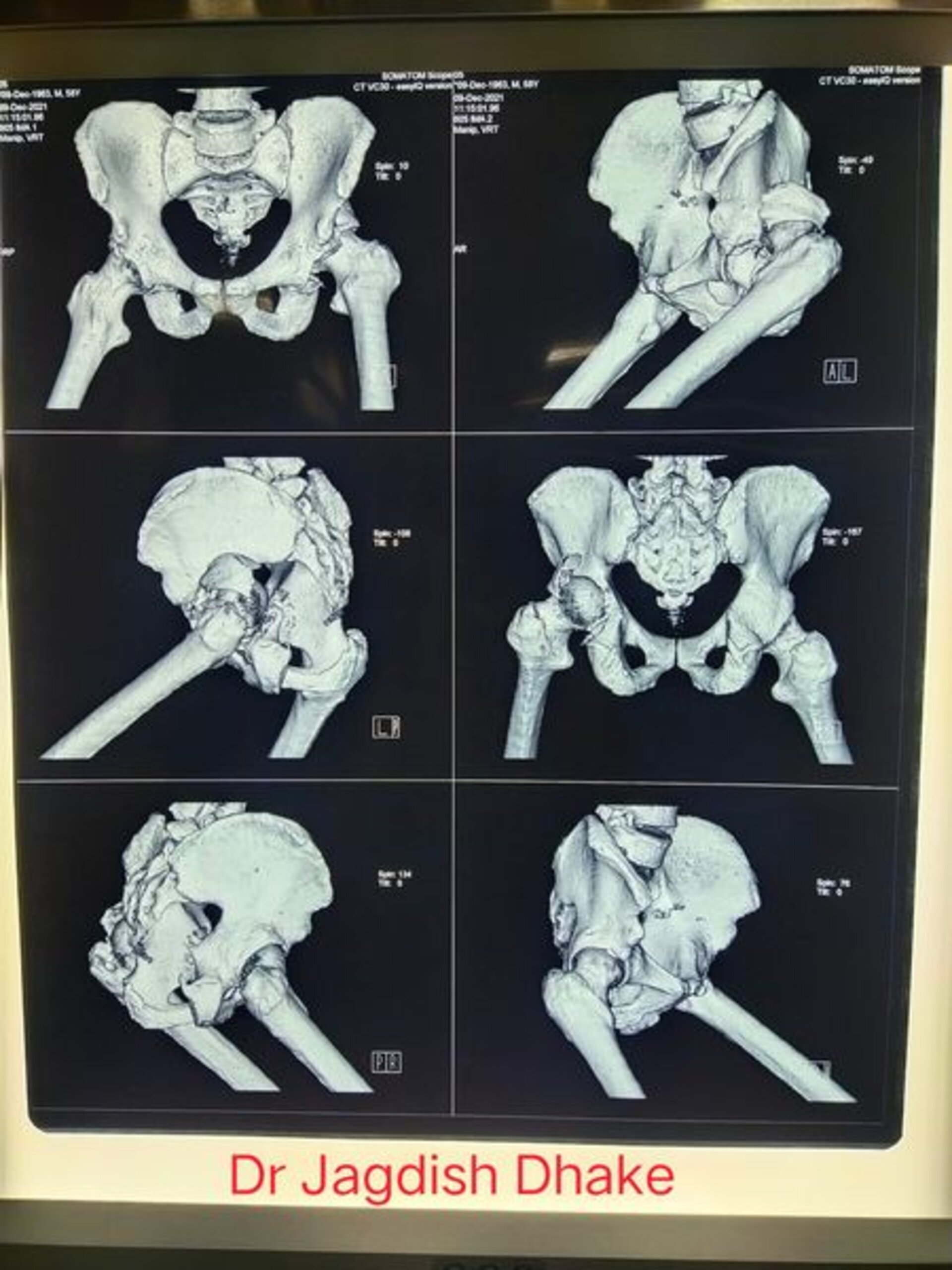 Comminuted acetabular fracture fixation | Dr. Jagdish Dhake