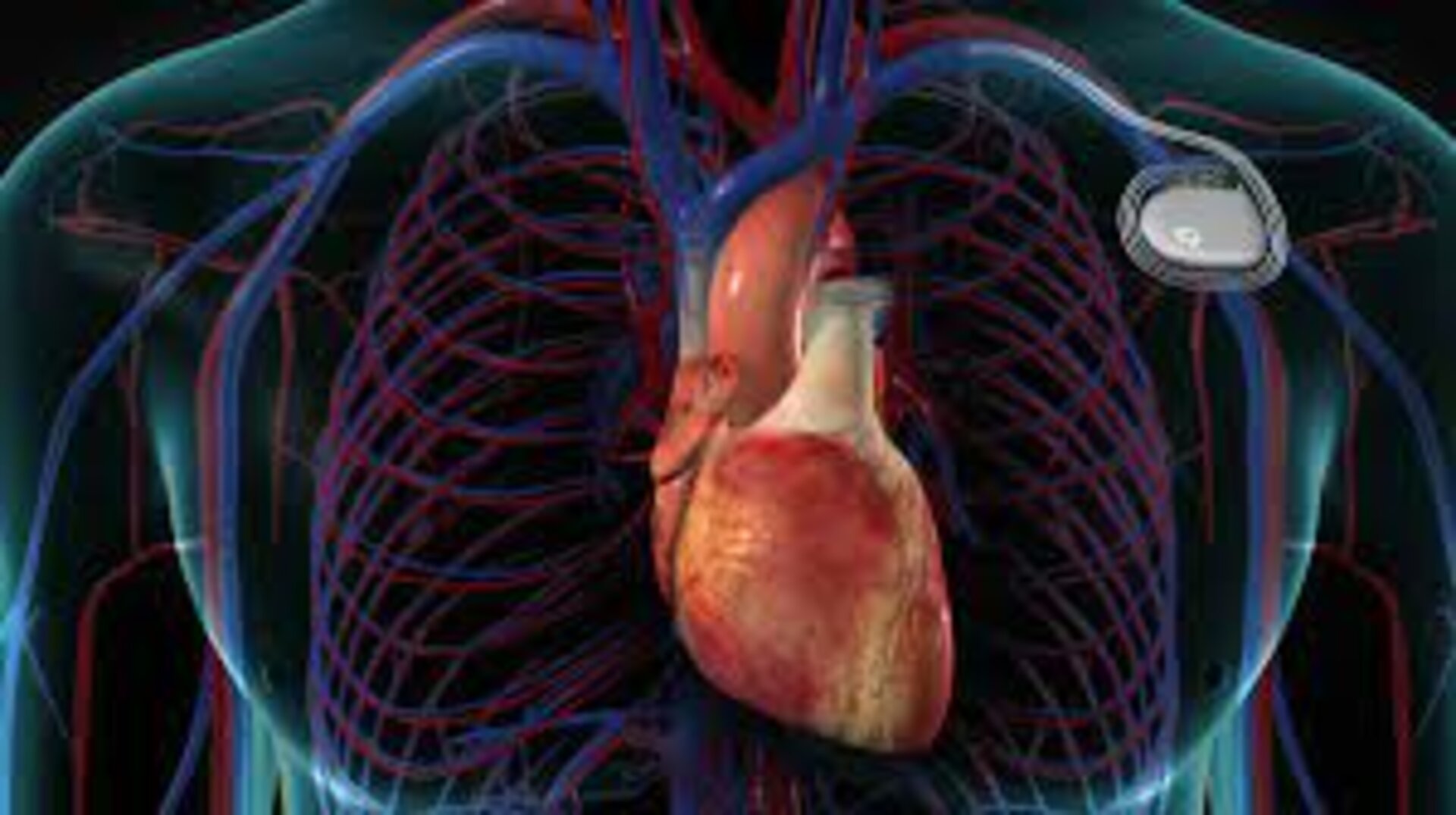 Cardiac Pacemaker Implantation