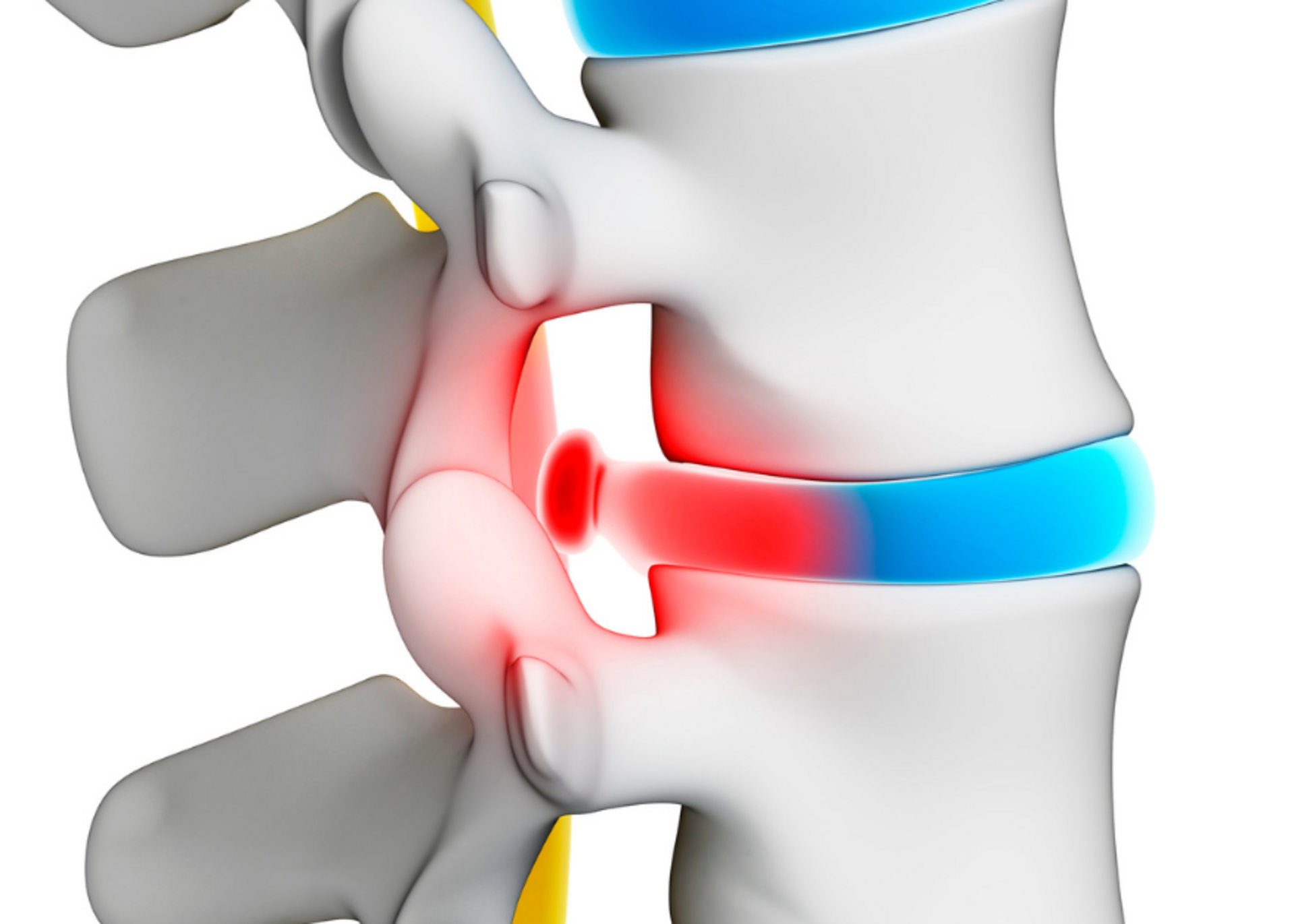 Herniated Disc | Dr. Paresh Bang