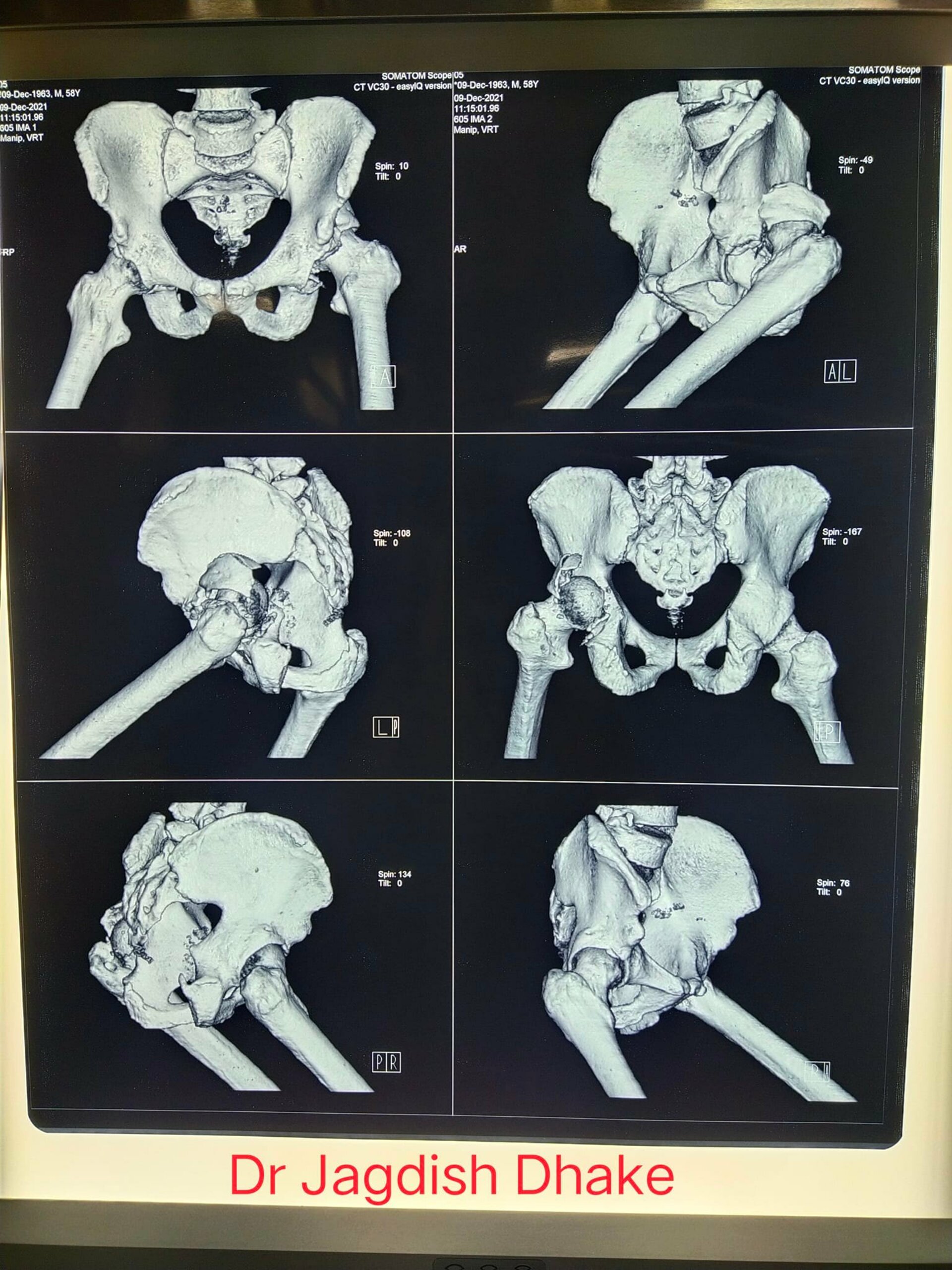 reconstruction of hip by Dr. Jagdish Dhake