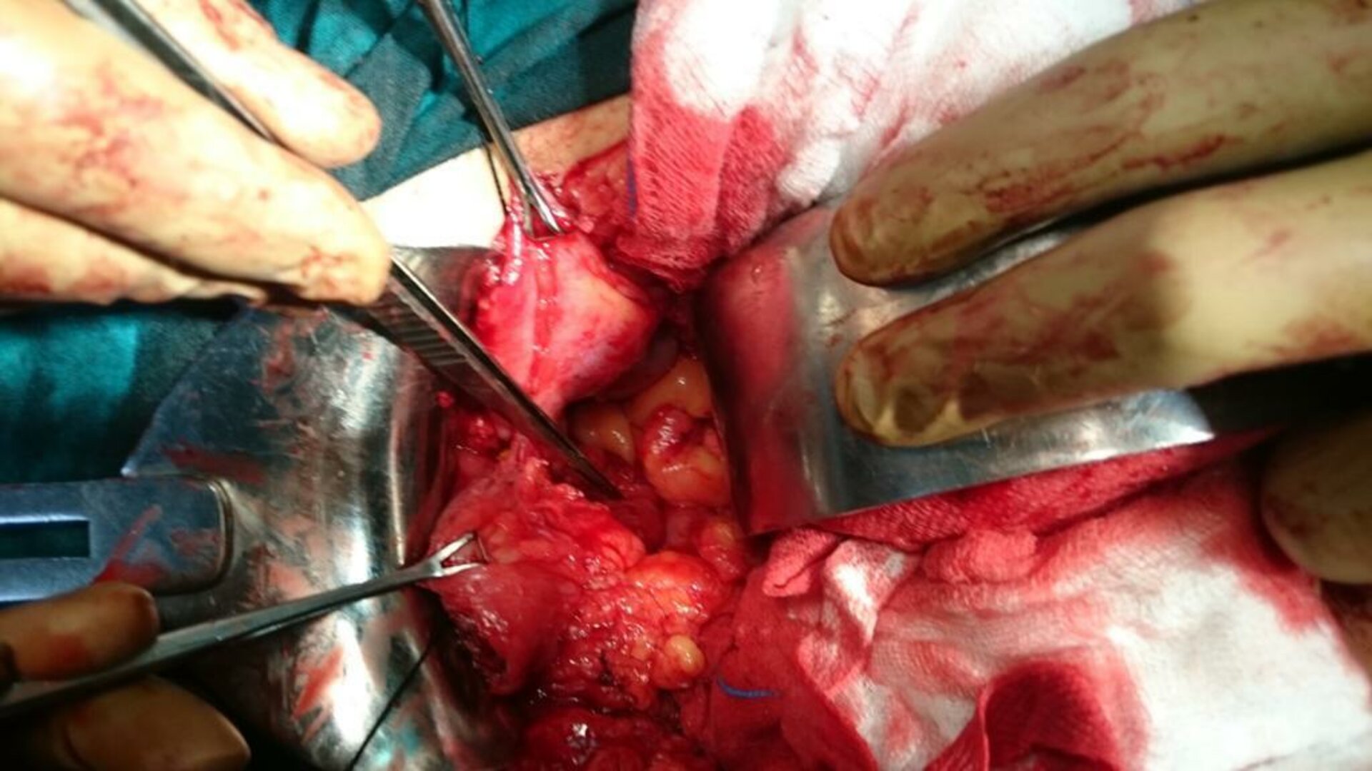 Difficulty in Urinating Treatment by VVF repair | Dr. Bhoopat Bhati