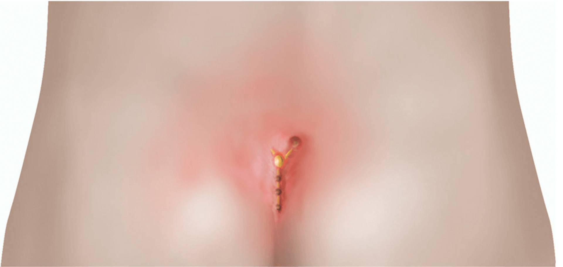 Pilonidal Sinus | Dr. Hina Khan