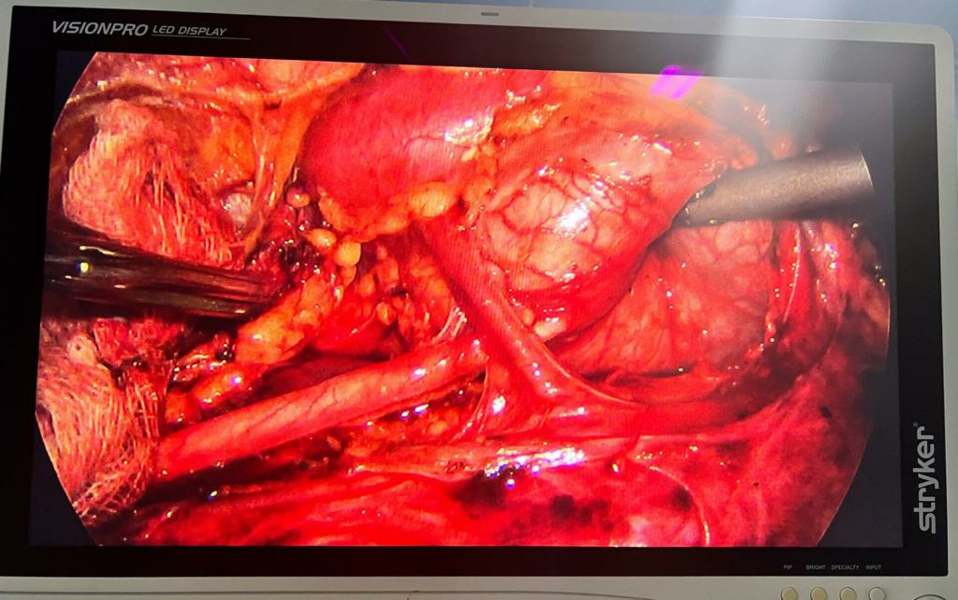 Abdomen Pain caused by PUJ Obstruction by Laparoscopic Pyeloplasty | Dr. Bhoopat Bhati