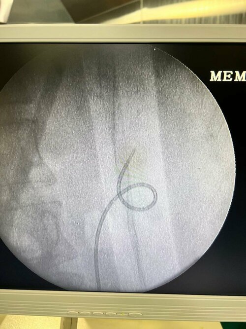 RIRS procedure.