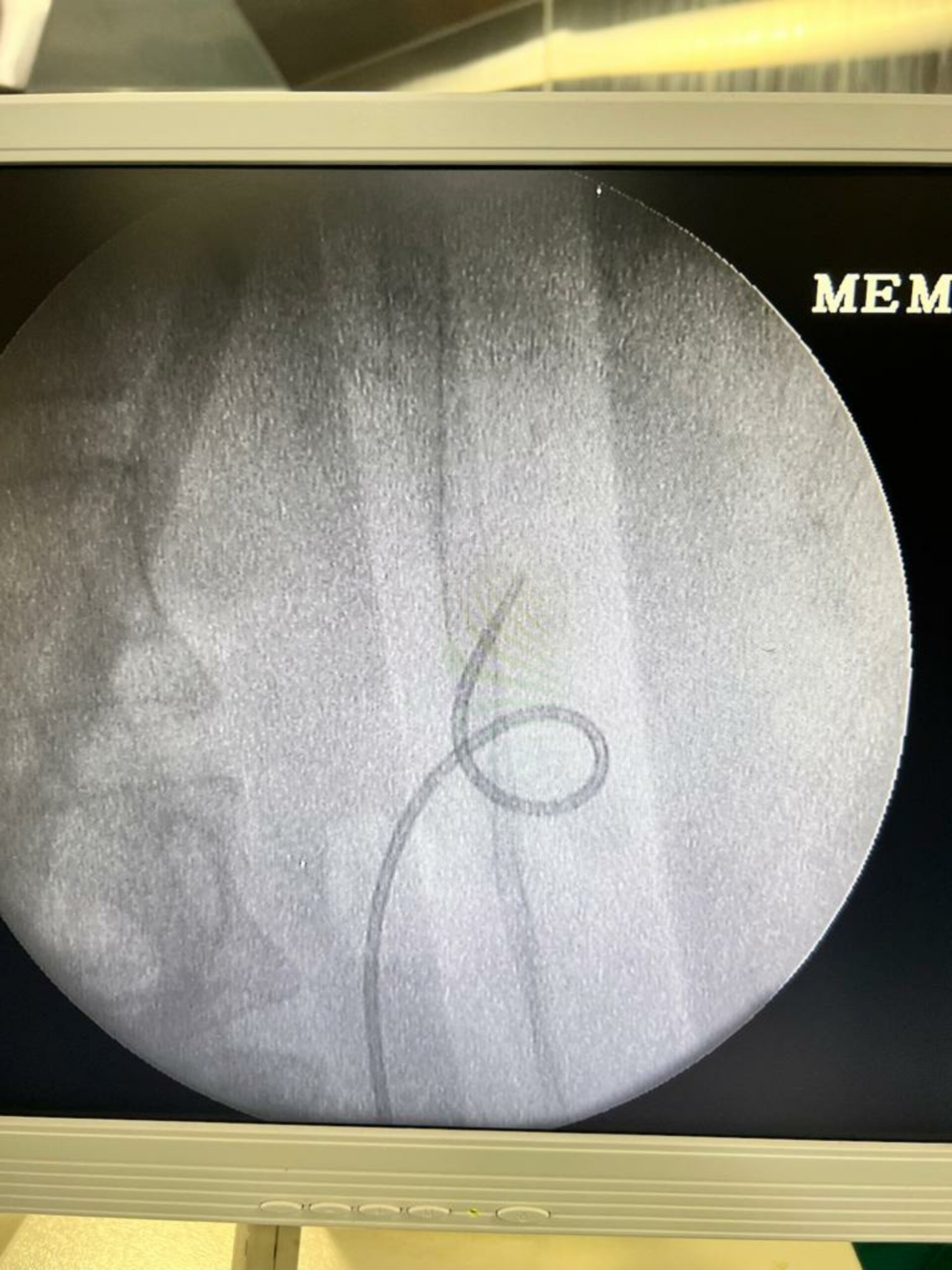 RIRS procedure.