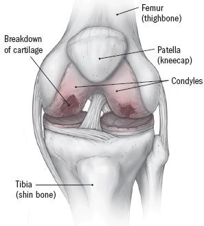 Dr. Sandeep Chauhan explains - What is Osteoarthritis and How Does It Affect You?