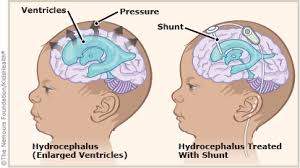Brain Surgery - Dr Prashant Khandelwal