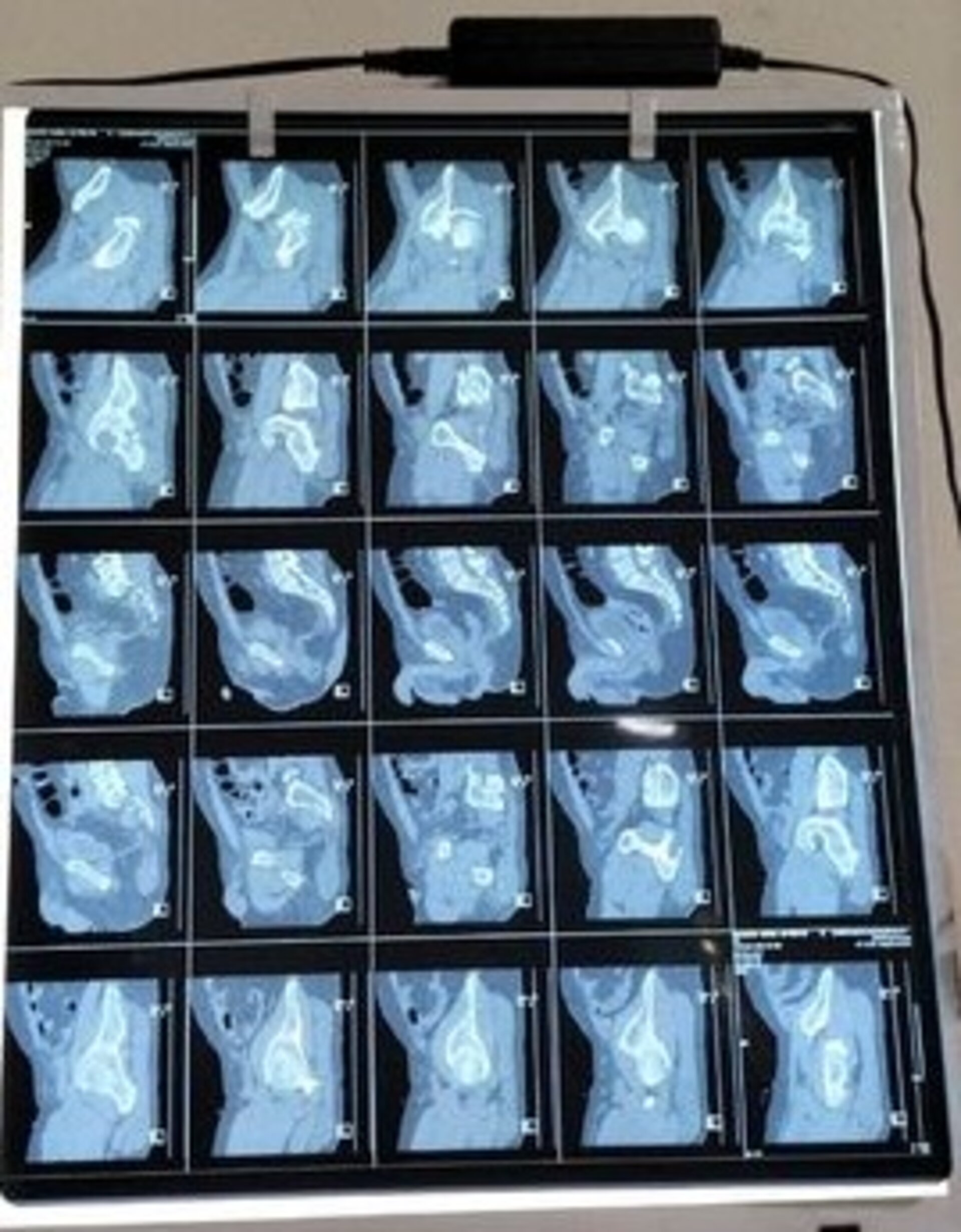 Comminuted acetabular fracture fixation | Dr. Jagdish Dhake