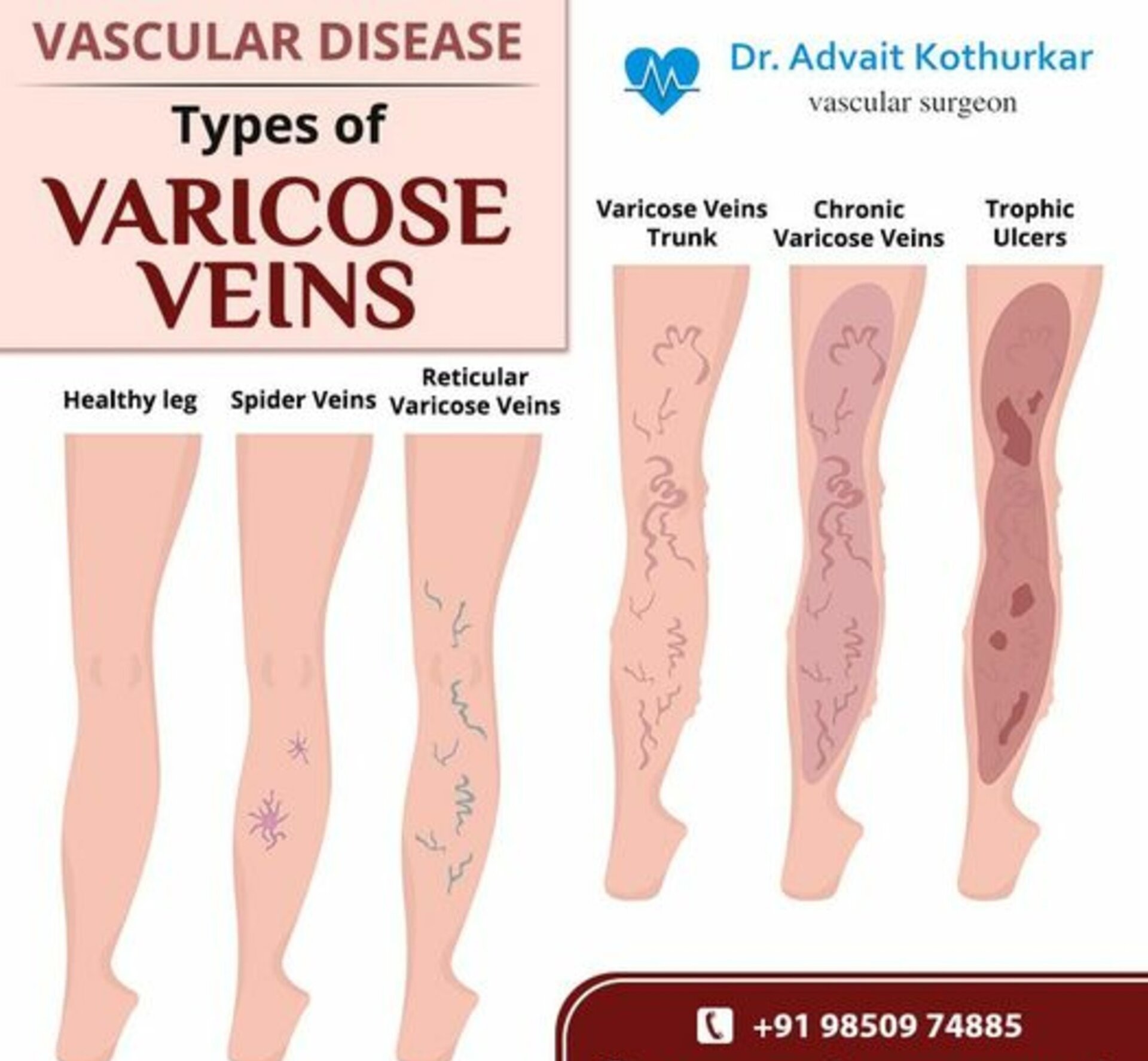 Vascular Disease - Types of Varicose Veins