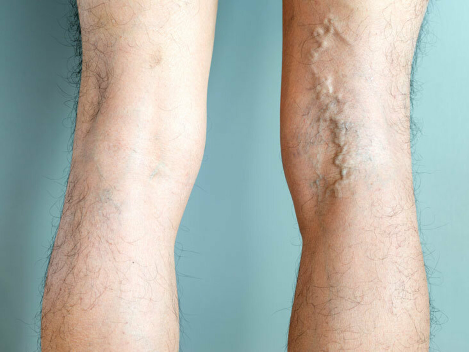 Surgery for Varicose Veins | Dr. Advait Kothurkar