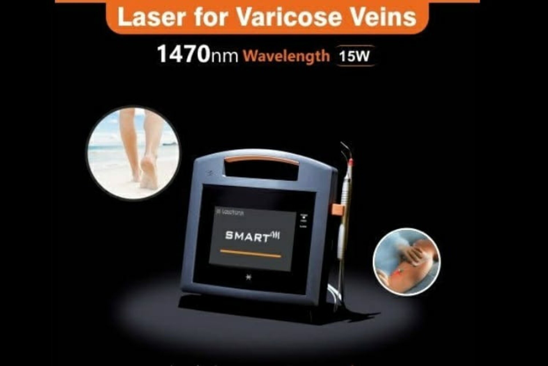 Varicose Veins